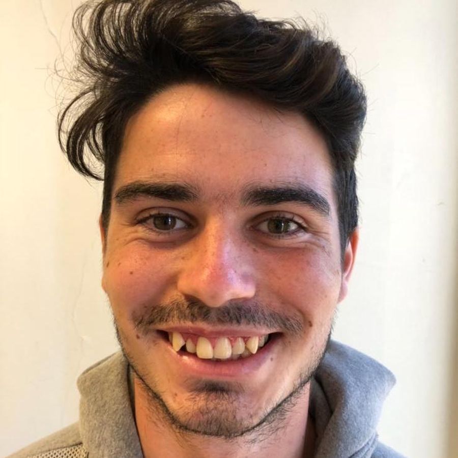 6 month braces - before - 3Dental